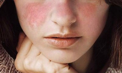 Tại sao bệnh lupus ban đỏ có thể gây ra suy thận?